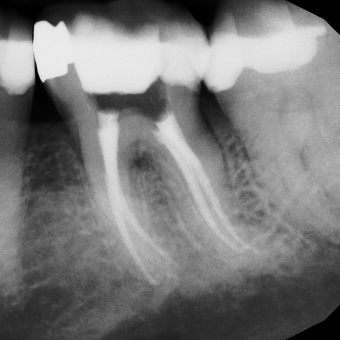 After Endodontic Treatment Case 4 - Harp Endodontics Manhattan New York